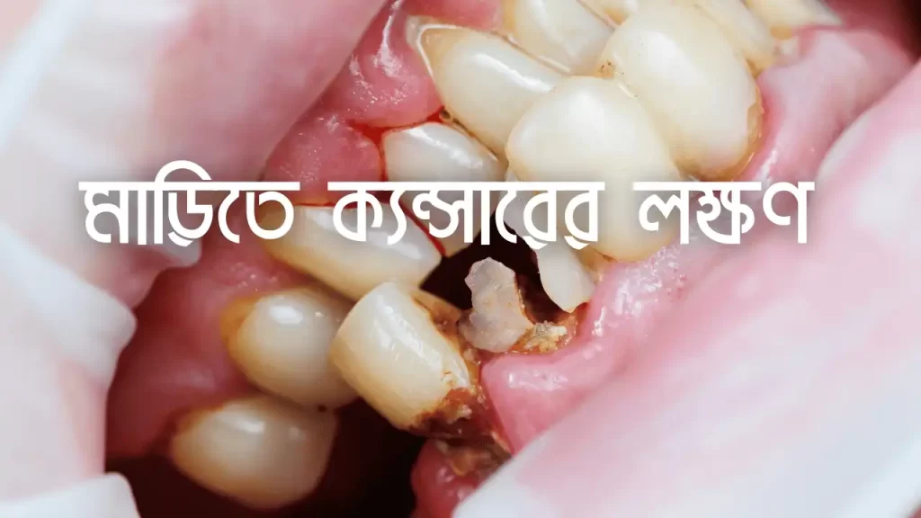 দাঁতের মাড়িতে ক্যান্সারের লক্ষণ